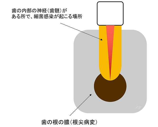 米国式歯内療法