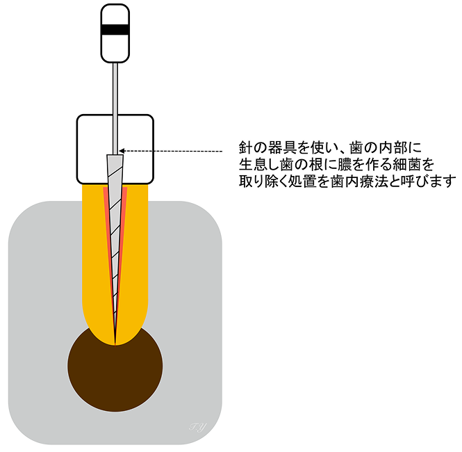 米国式歯内療法