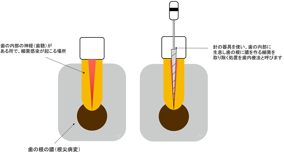 米国式歯内療法