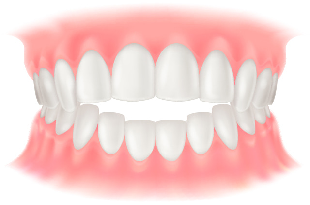 開咬のイラスト