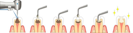 削らないむし歯治療(カリソルブ)のイメージイラスト
