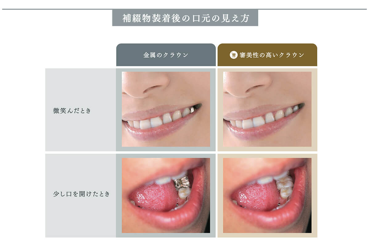 当院で取り扱う詰め物・被せ物の特徴01