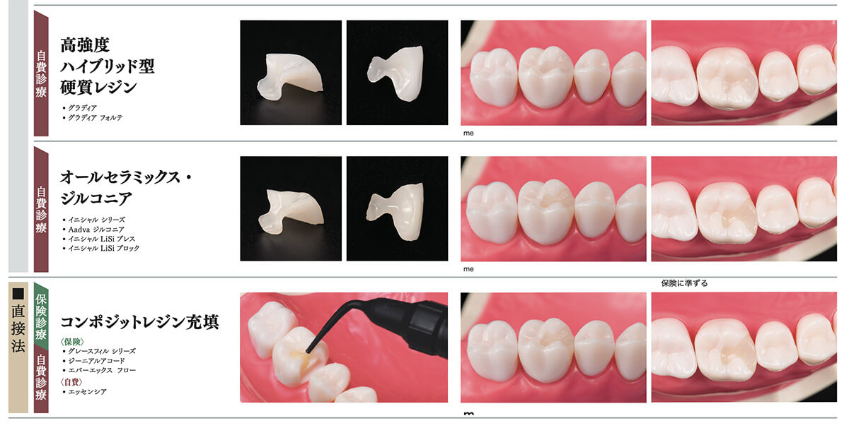 当院で取り扱う詰め物・被せ物の特徴03