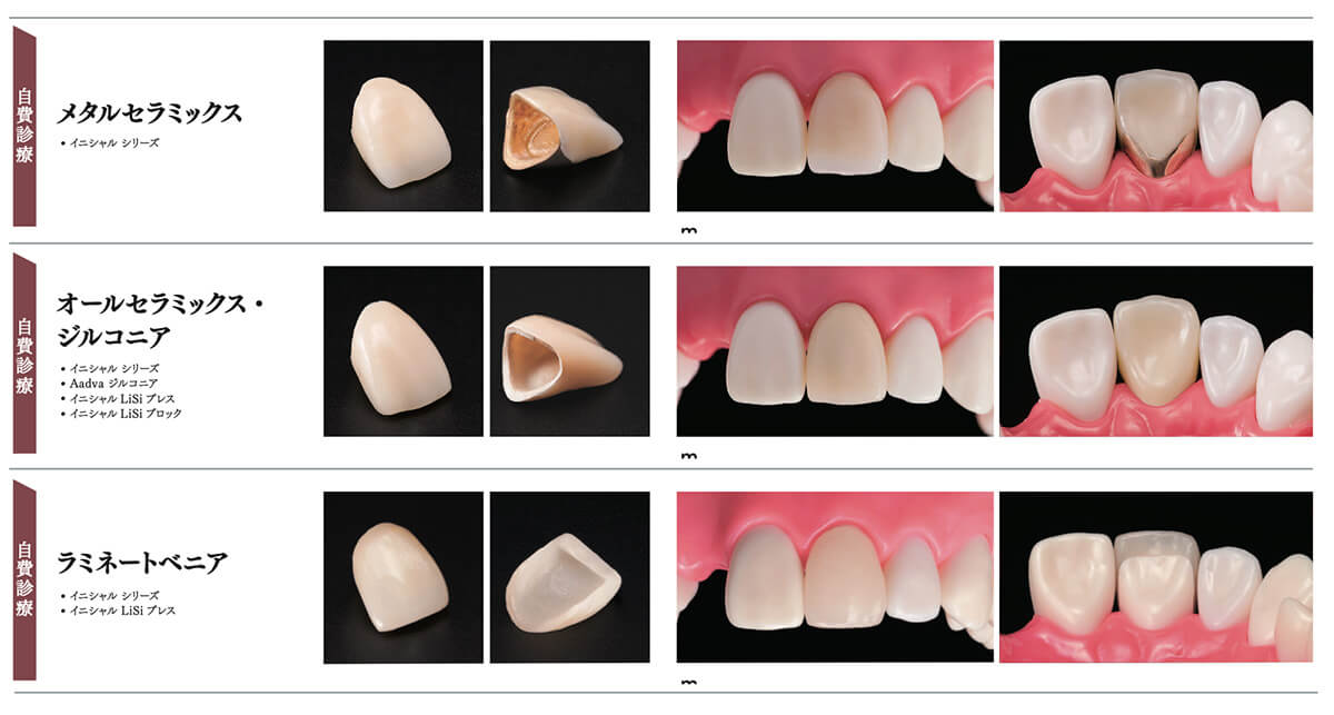 当院で取り扱う詰め物・被せ物の特徴05