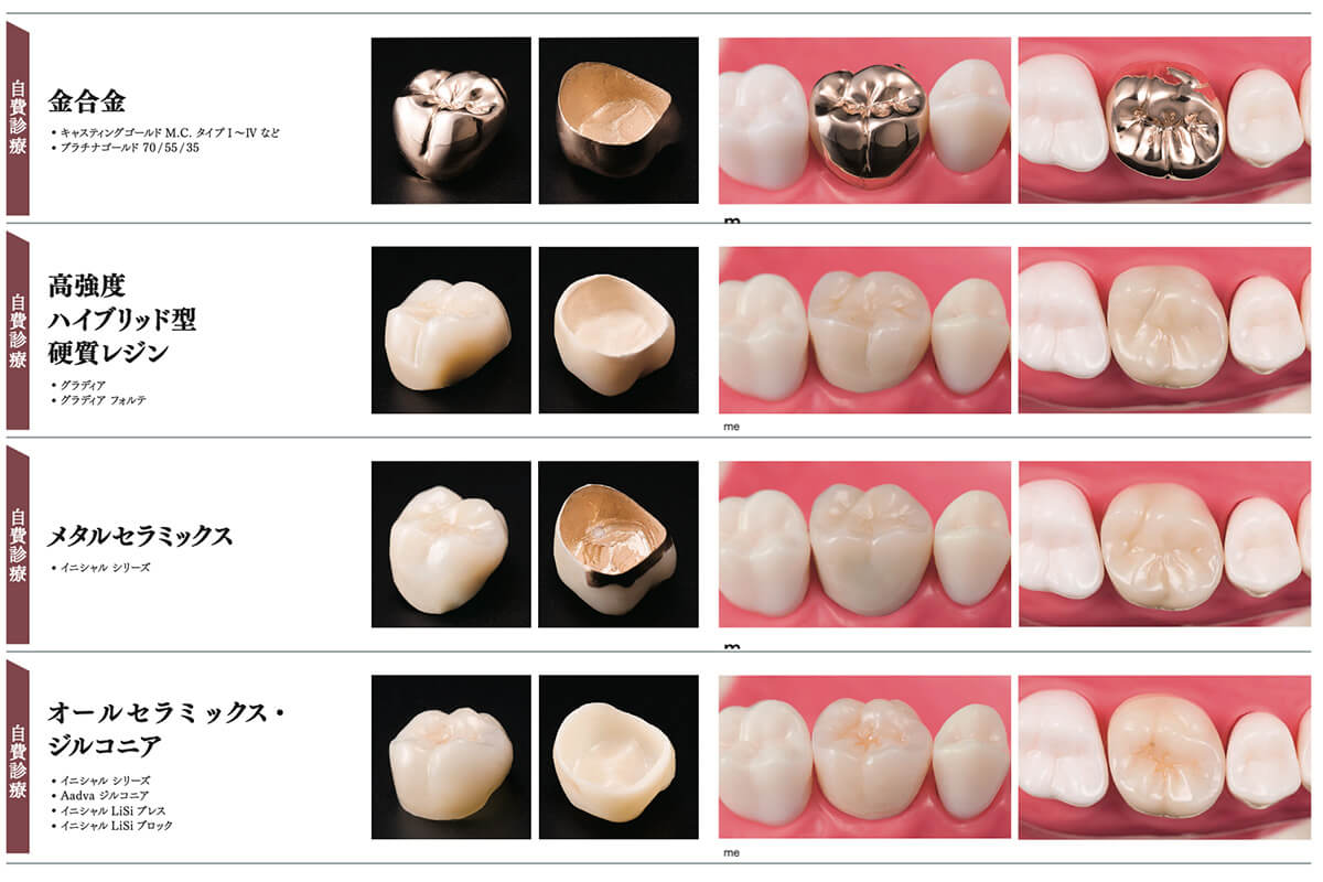 当院で取り扱う詰め物・被せ物の特徴07