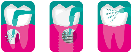 治療イメージ図