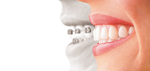 金属アレルギーの方でも安心