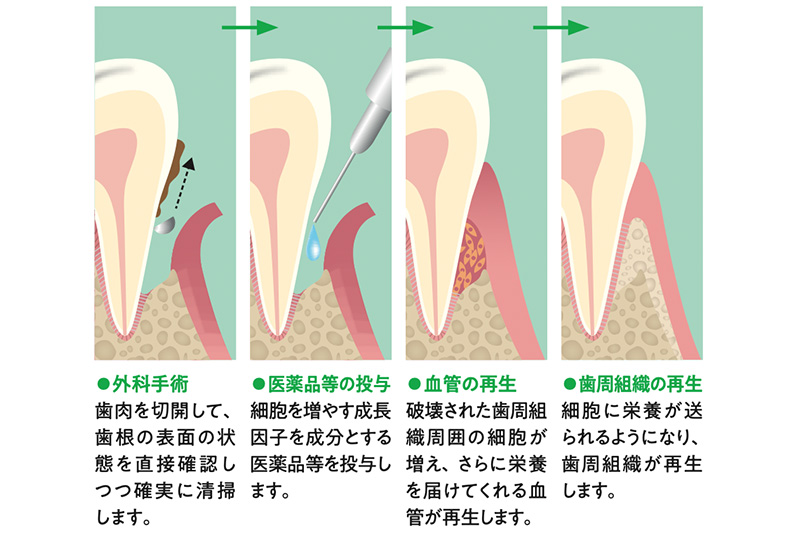 リグロスによる歯周組織再生療法