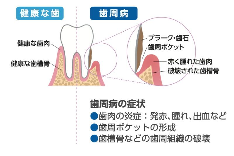 正常な歯と歯周病の比較