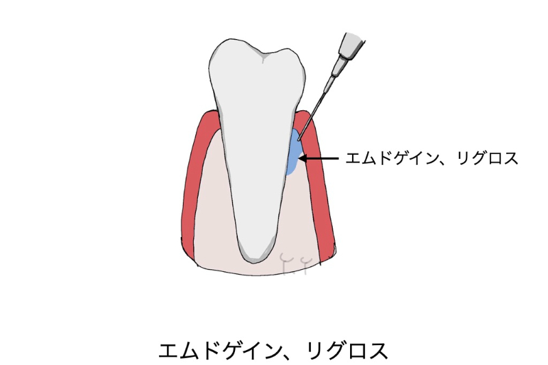 再生(エムドゲイン、リグロス)