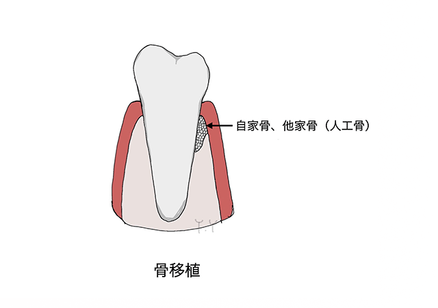 再生(骨移植)