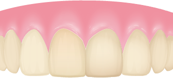 医療ホワイトニングのメカニズム06