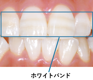 白い線模様(ホワイトバンド)あり