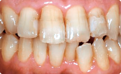 ホワイトニング前の写真