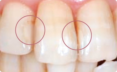 ホワイトニング後の写真