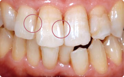 詰め物の処置後写真