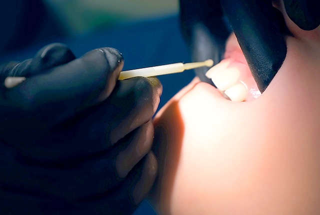 フッ素塗布(フッ素化物)