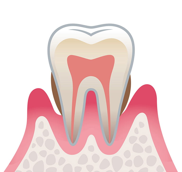 中度歯周病のイラスト