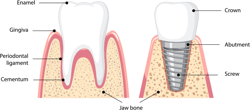 インプラントのイラスト